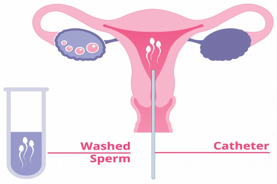 Intrauterine Insemination (IUI)