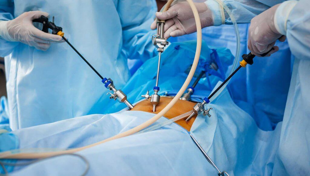 Laparoscopic Surgeries