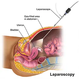 Laparoscopic Surgeries